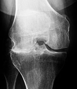 knee xray